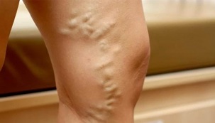 causes des varices chez les femmes